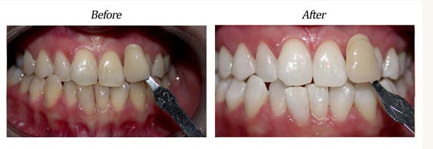 pain after zoom whitening